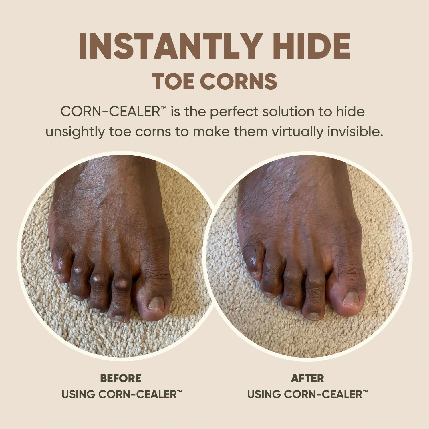 Toe Corn Concealer