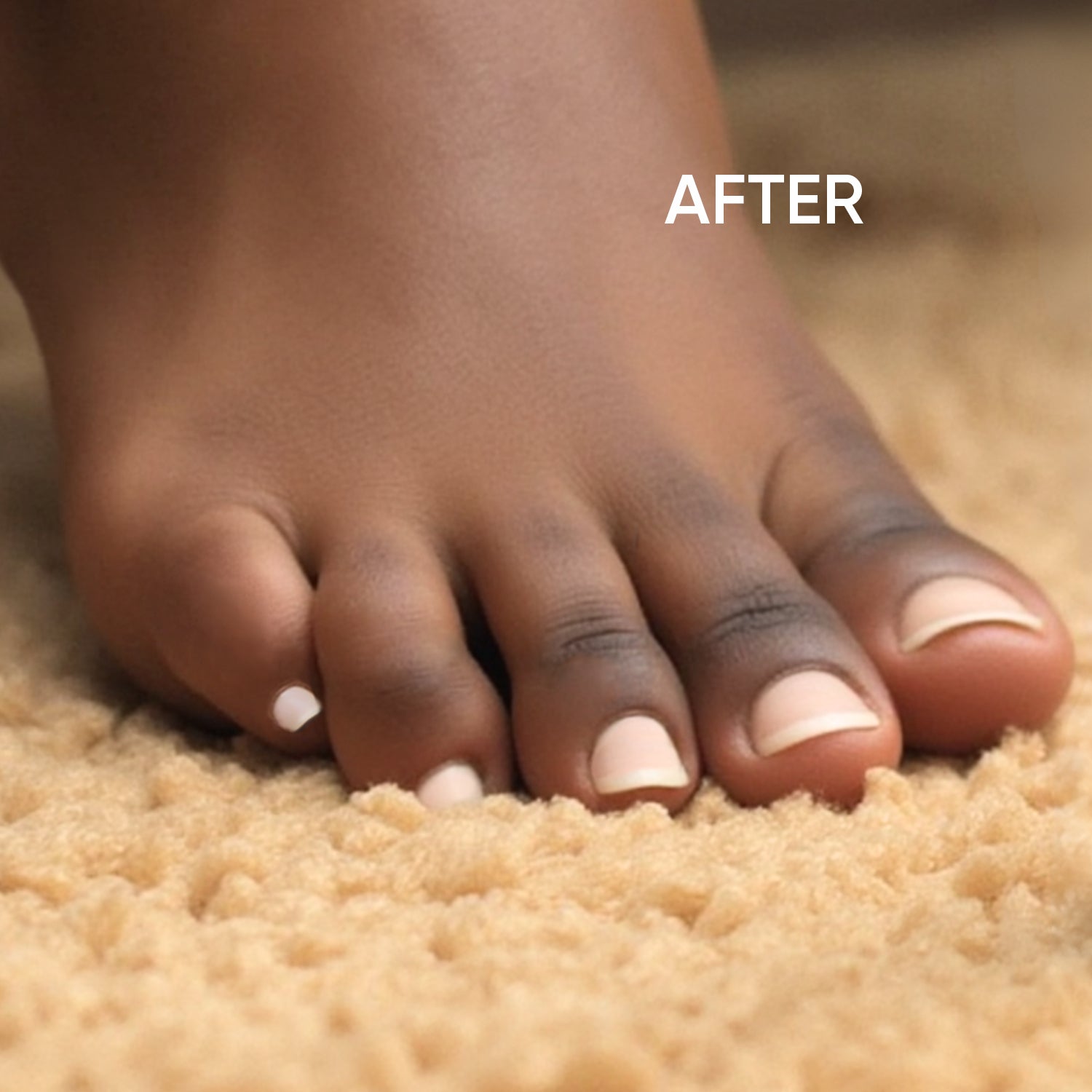 Closeup of black woman's toes with corns covered using Corn-Cealer.