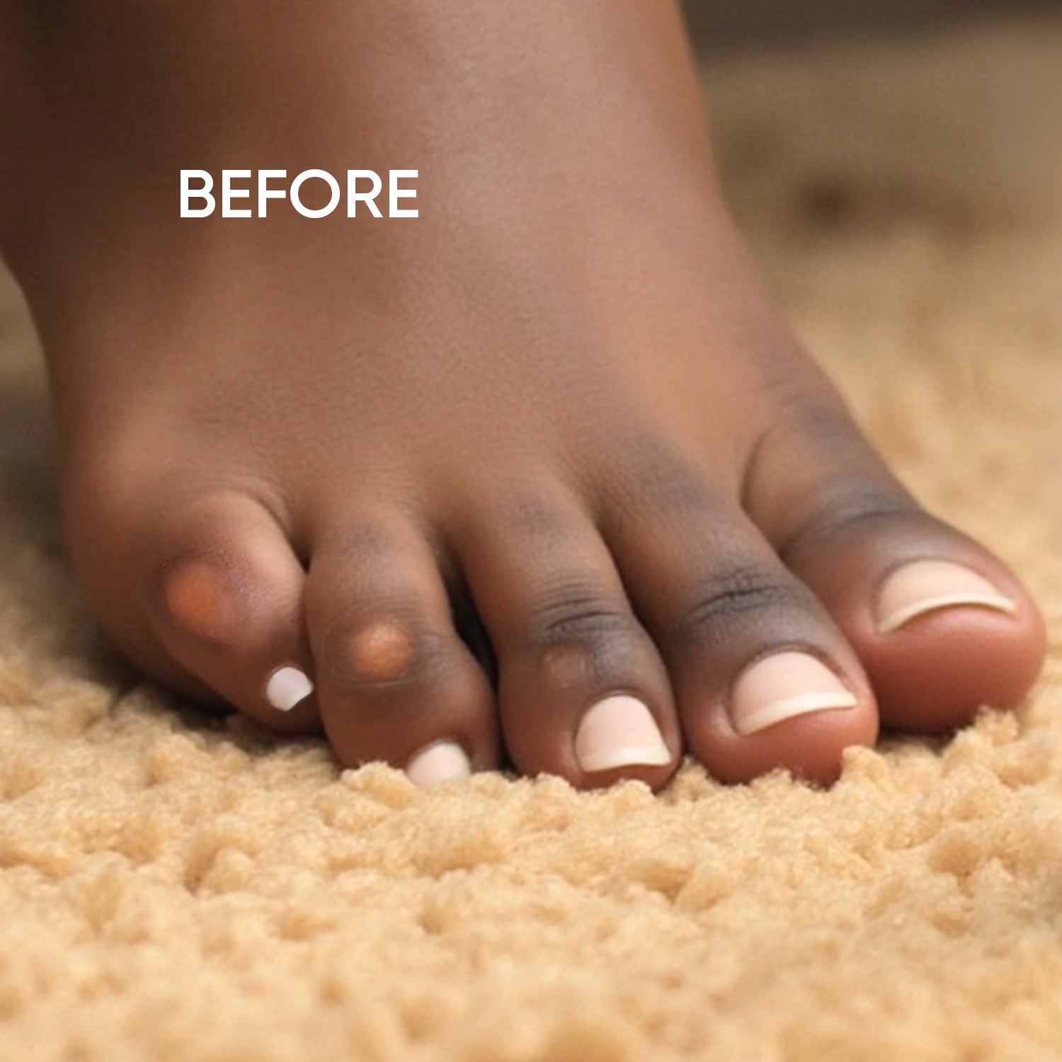 Close-up of a Black woman's toes with visible corns before Corn-Cealer Toe Corn Makeup is applied.